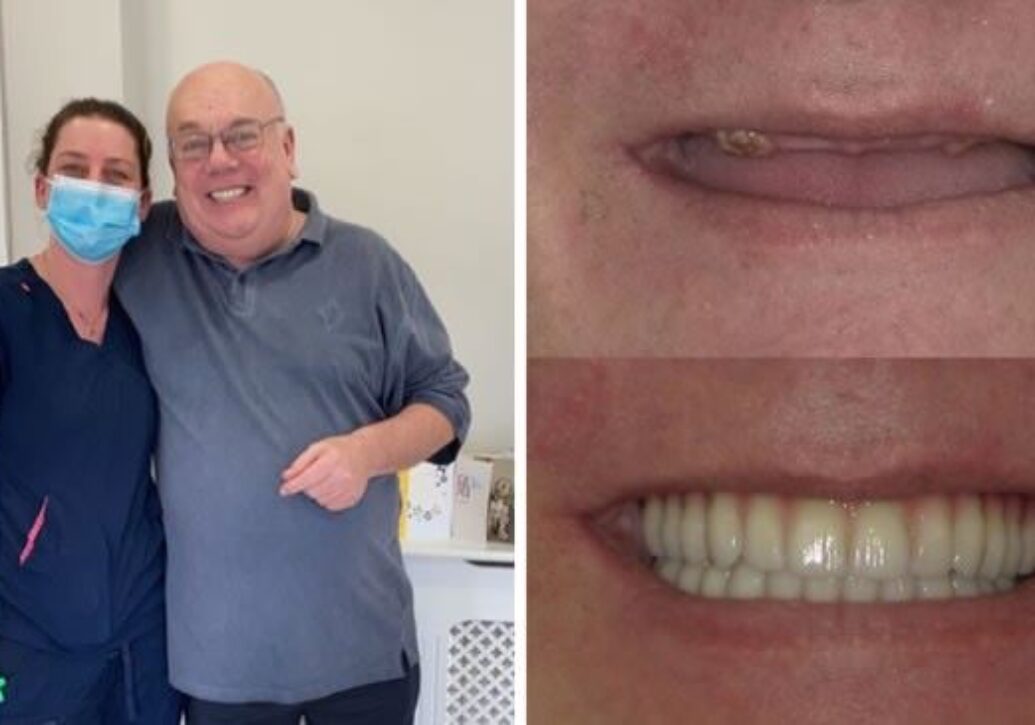 Happy smile transformation from a nervous patient dental implants Fusion Dentistry