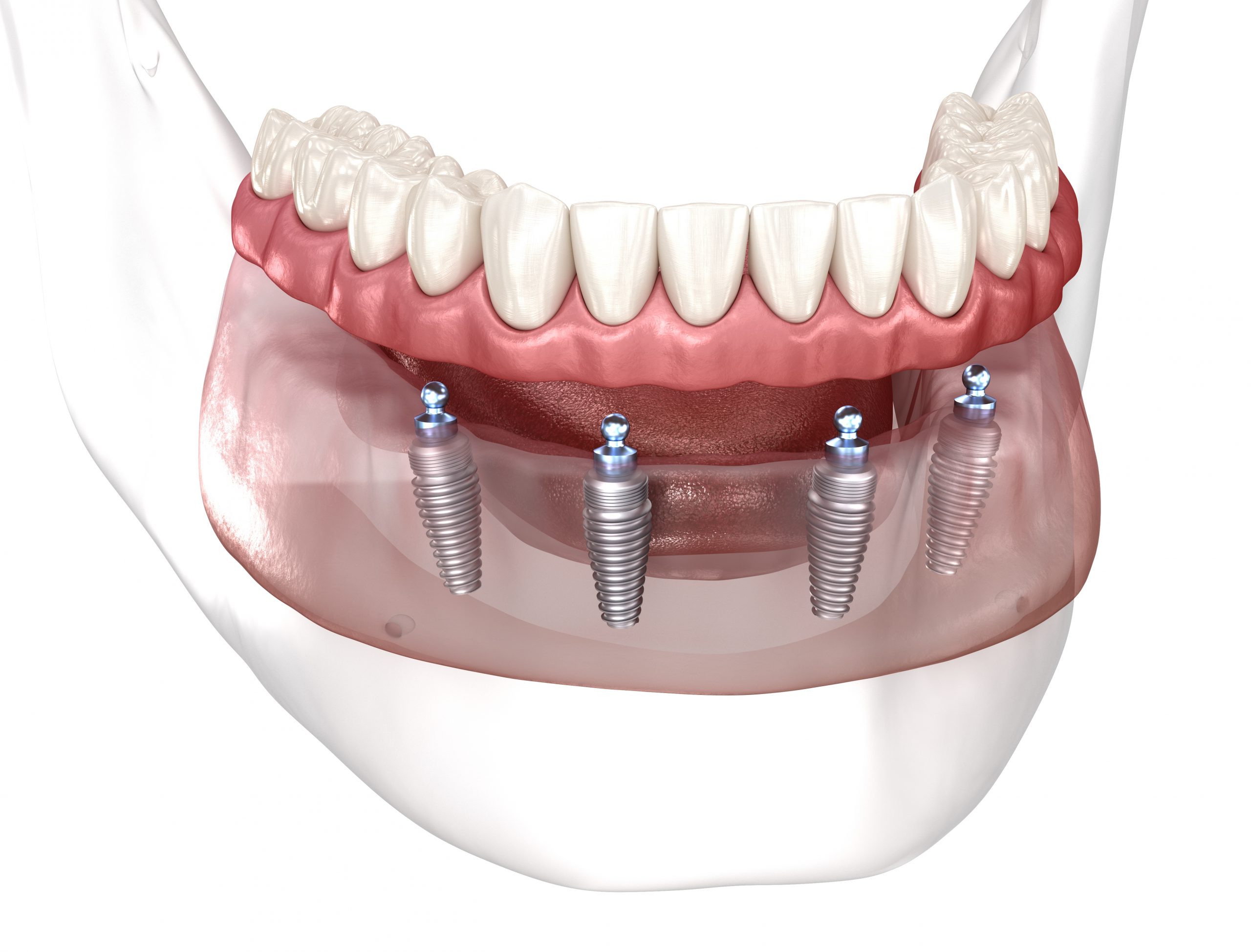 All-on-4 Dental Implants