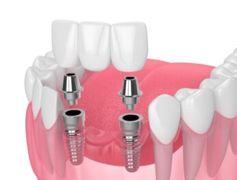 Fusiondental Dental Implant Image