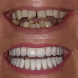 Bright new smile after dental implants