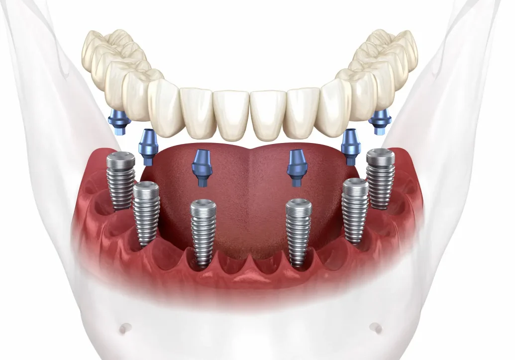 All on 6 dental implants