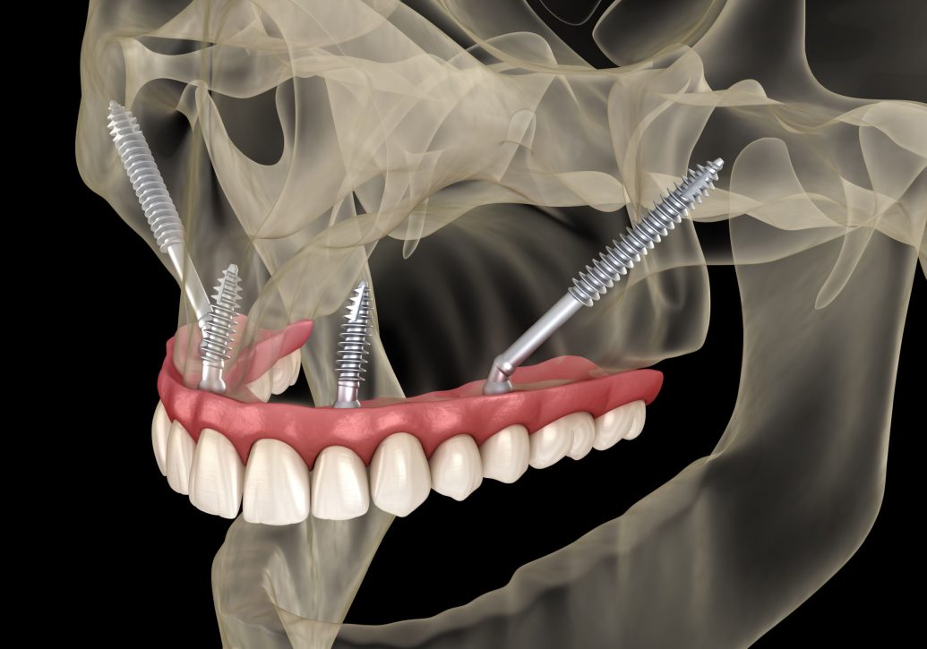 Medical illustration of zygamatic dental implants