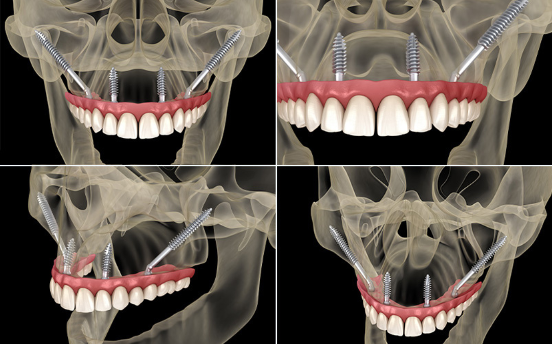 Zygomatic Dental Implants Medical Illustration